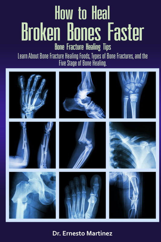 How to Heal Broken Bones Faster. Bone Fracture Healing Tips: Learn About Bone Fracture Healing Foods, Types of Bone Fractures, and the Five Stages of Bone Healing (Health and Wellness)